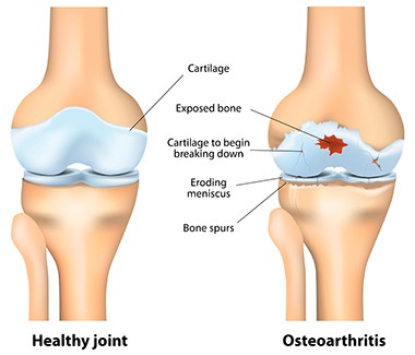 Osteoarthritis Treatment Sidney, Oh